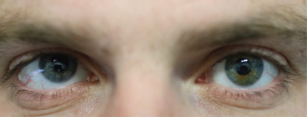 Strabismus Surgery In Canberra Clarity Eye Surgeons