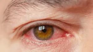 Dry eye syndrome after cataract surgery