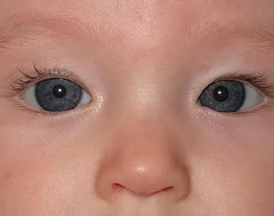 Strabismus Surgery in Canberra