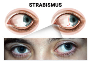 strabismus in adults