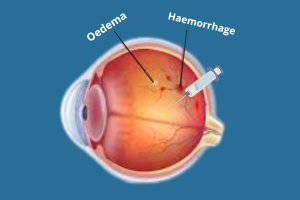 Retinal Vein Occlusion with Eye Injections