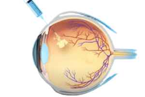 eye injections in diabetic retinopathy